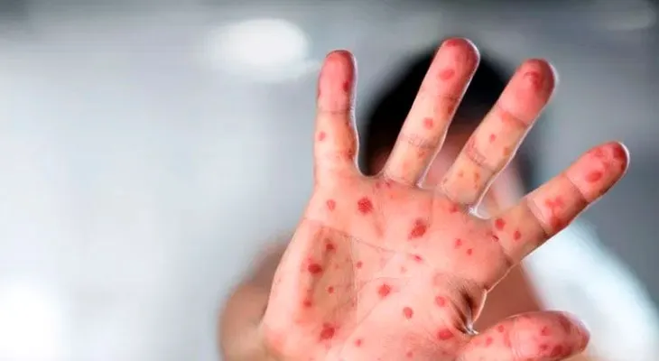 Unicef advierte de un aumento "alarmante" del sarampión a nivel mundial