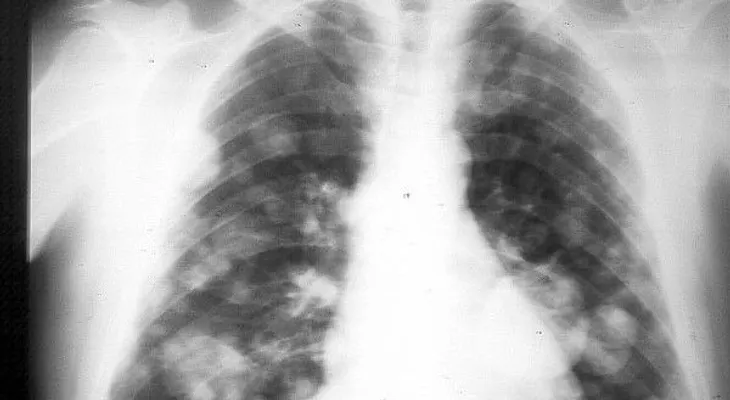 5 factores riesgo cáncer de pulmón