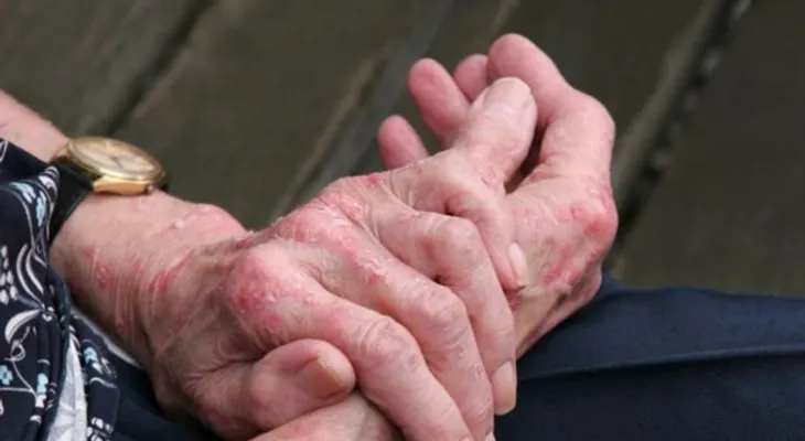 El Lupus Eritematoso Sistémico afecta distintos órganos del cuerpo