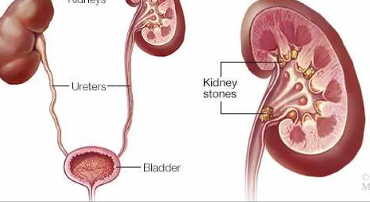 Estudio conecta la primera formación de cálculos renales con enfermedad renal crónica