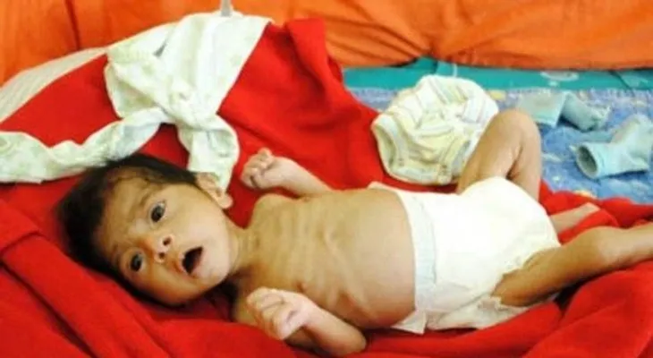 Latinoamérica afectada por una desnutrición crónica 