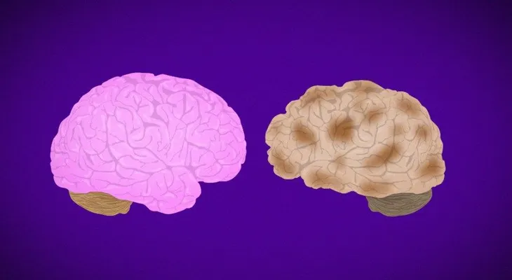 No, el Alzheimer no es contagioso