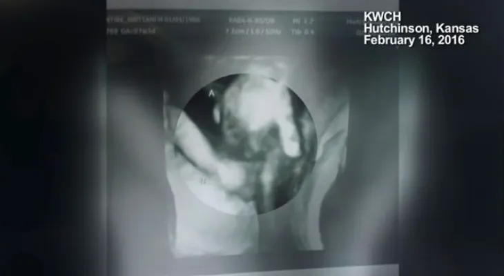 Asombrosa imagen de ultrasonido muestra a mellizo moribundo tomando la mano de su hermana