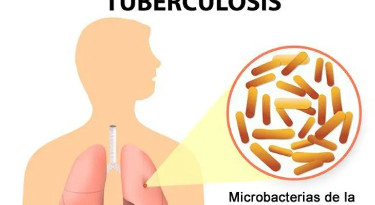 8 remedios muy eficaces para la tuberculosis