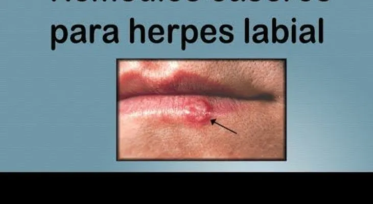 Como frenar un herpes labial con este sencillo truco (VIDEO)