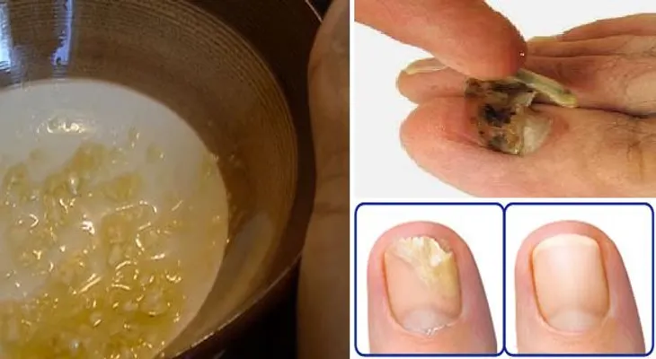 Se llama destroza hongos porque elimina todos los hongos de las uñas de una pasada