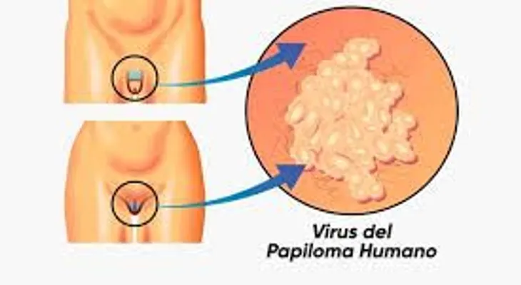 El virus del Papiloma humano y los beneficios de la vacuna; descubre todo sobre esta enfermedad