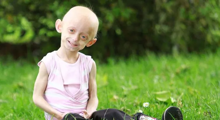 Progeria: Rara enfermedad que acelera el envejecimiento