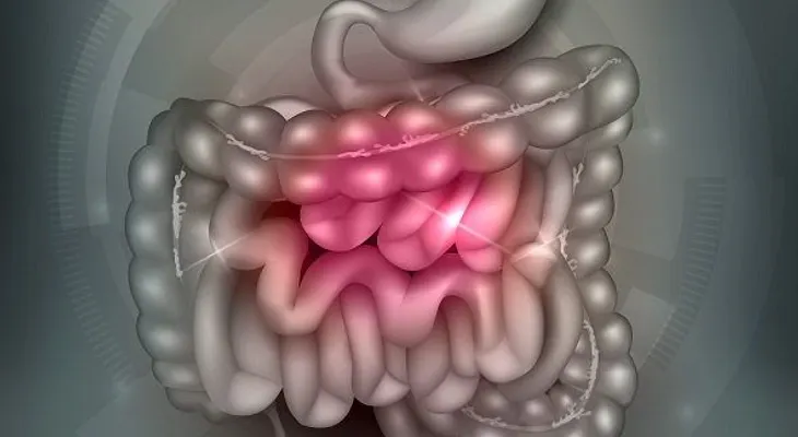 Colon irritado sus causas y remedios para tratarlo