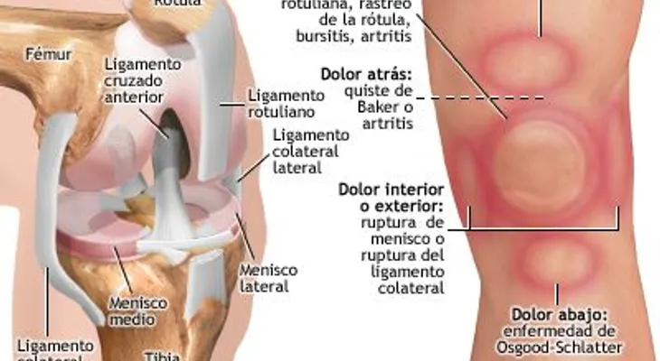 Riesgos de la artroplastia de cadera y de rodilla
