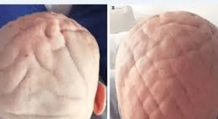 Un hombre va al médico por su cabeza con forma de cerebro; sufre de acromegalia