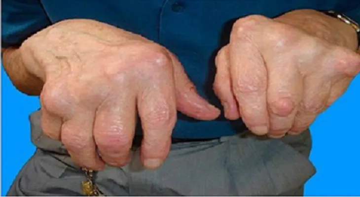 Olvídate de la artritis con la ayuda de este remedio natural recientemente descubierto