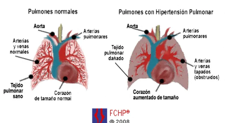La hipertensión pulmonar, síntomas y causas
