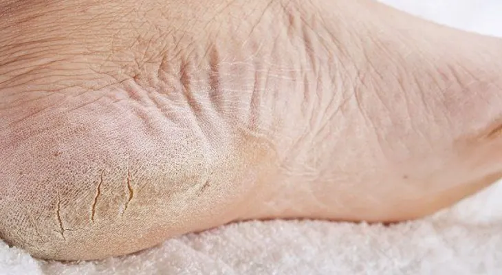 Cómo deshacerse de los pies secos con remedios naturales