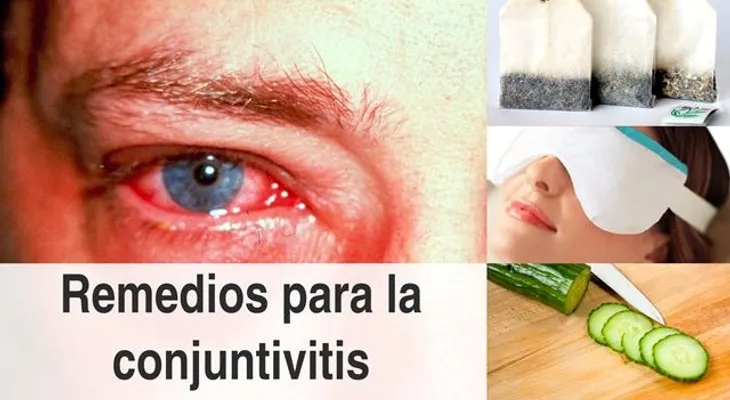 La conjuntivitis; remedios caseros 100 efectivos para curarte