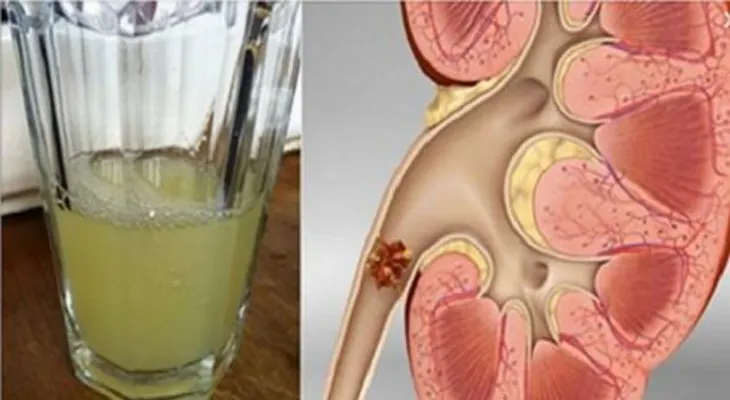 Observa como salen expulsadas todas las piedras del riñón con solo beber este remedio natural