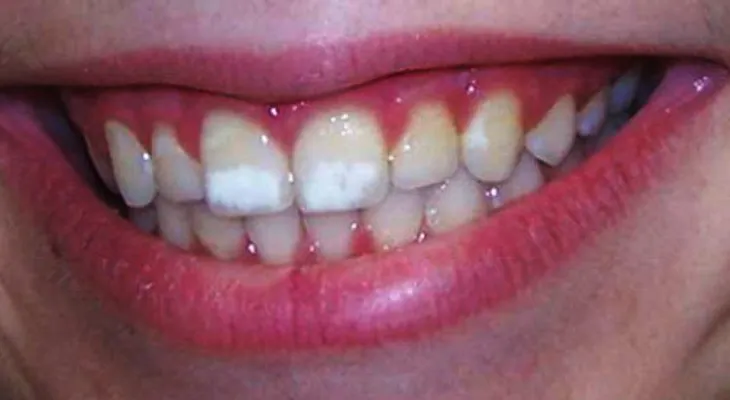 Qué son las manchas blancas en los dientes