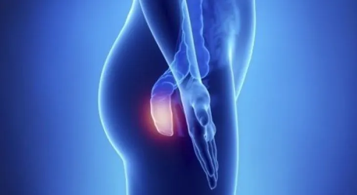 5 síntomas del cáncer de ano, una enfermedad silenciosa 