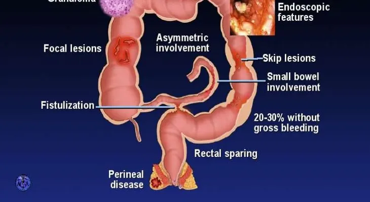 Todo lo que debe saber sobre la enfermedad de Crohn