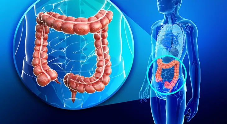 Cáncer colorrectal va en aumento y causa 112.000 muertes al año en América 