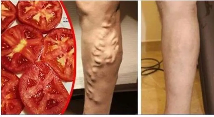 El remedio de un doctor para acabar con las varices en las piernas: tomates verdes y tomates rojos maduros