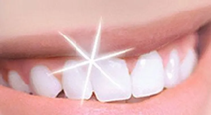 Cosas que debes saber antes de blanquear tus dientes