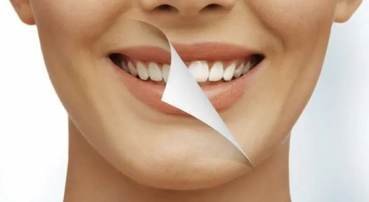 ¿Cómo blanquear los dientes en una hora?