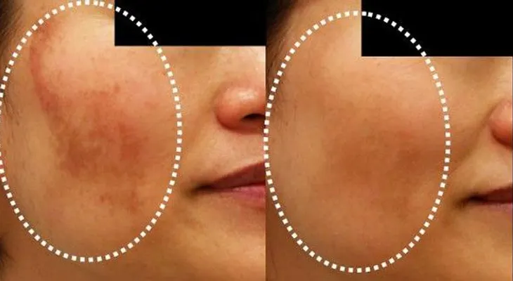 Nuevo tratamiento para el melasma (Manchas en el rostro)