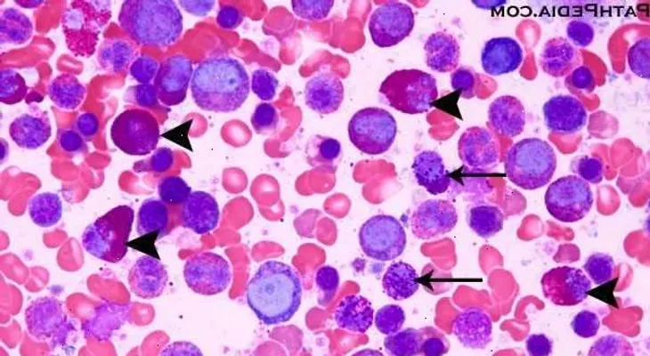 Mielofibrosis: enfermedad detectada en la tercera edad