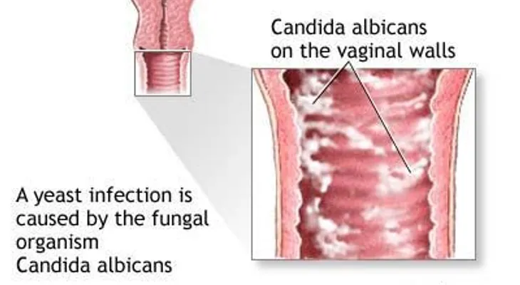 Como curar hongos vaginales con betedine vaginal