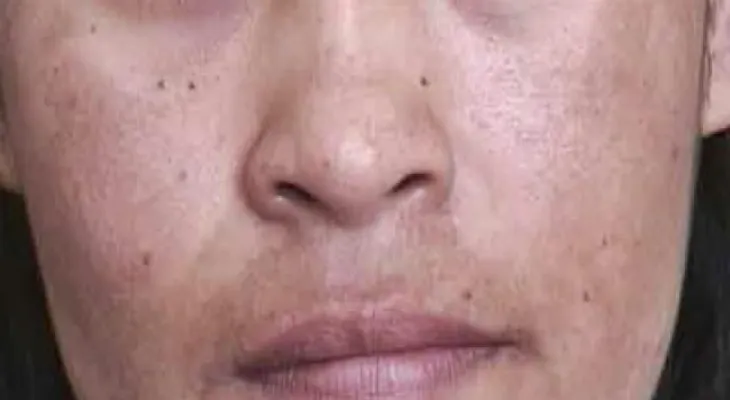 Cómo eliminar las manchas de la cara