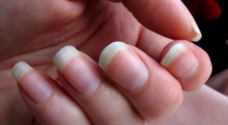 Cambios en las uñas que te muestran problemas de salud