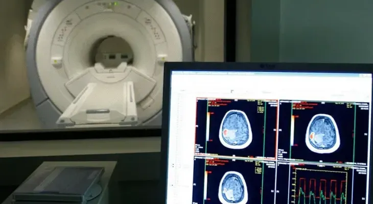 Chilenos proponen tratamiento contra el alzhéimer con nanopartículas de oro