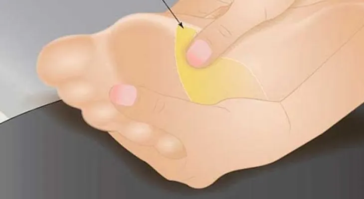 Como aliviar tu dolor de cabeza con reflexología en los pies