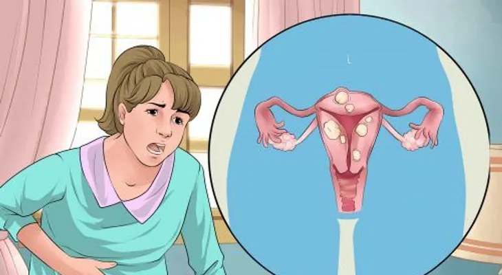 Los 4 trastornos menstruales y remedios que son muy EFECTIVOS 