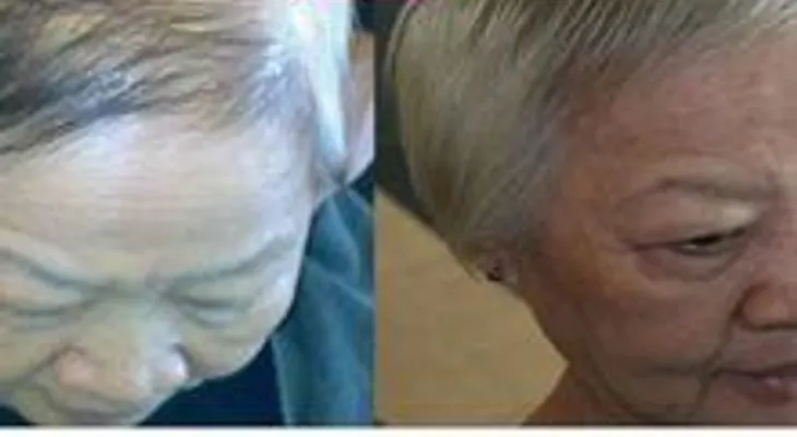 Ponte unas gotas de este jarabe en tu cuero cabelludo y tu pelo volverá a crecer...¡impresionante!
