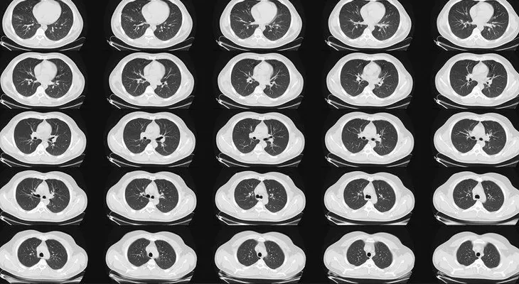 Publican nuevas pautas para la detección cáncer de pulmón
