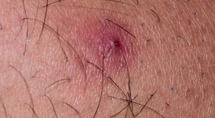 Cómo tratar la foliculitis
