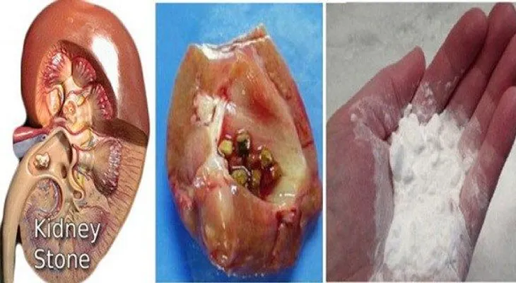 Cómo reparar los riñones de forma natural con bicarbonato de sodio