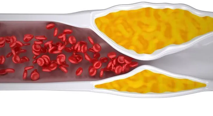 Tratamiento efectivo para la aterosclerosis