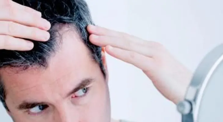Alopecia androgenética, ¿igual en hombres que en mujeres?