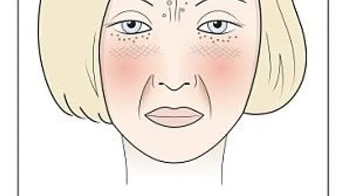 Leche, azúcar, gluten y alcohol pueden afectar la apariencia del rostro