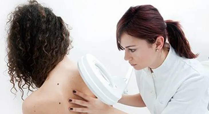 Los lunares podrían ayudar a predecir el riesgo de cáncer de mama