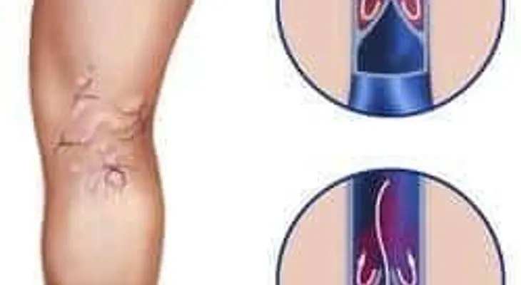 Tratamientos para las varices
