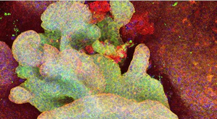 Los científicos observan por primera vez cómo nace el cáncer de piel