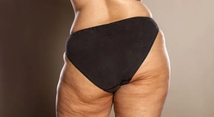 7 rituales matutinos para eliminar la celulitis