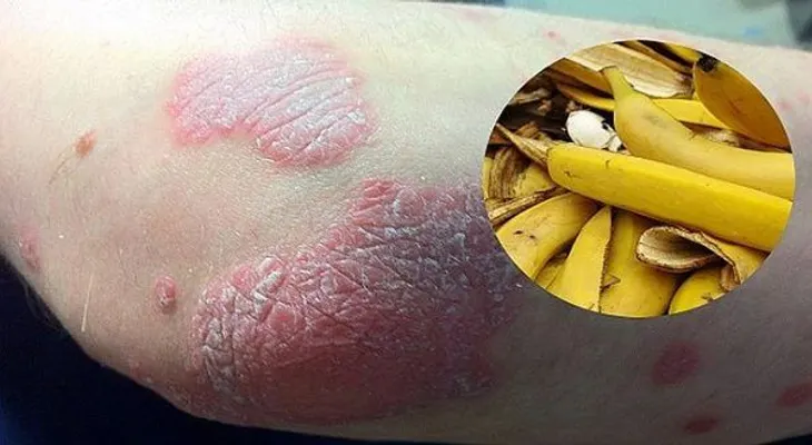 La cáscara de plátano es la solución para las arrugas, verrugas y psoriasis... ENTÉRATE!!