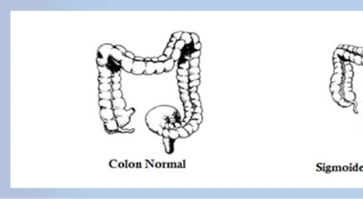 Limpieza del colon ayuda a bajar la barriga