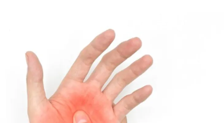 Ardor (sensación de quemadura) palma de la mano