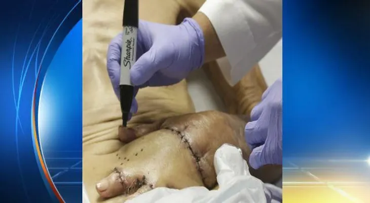 Un hombre salva mano quemada... dentro de su estómago
